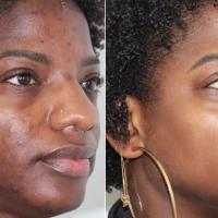 Acne_Bootcamp_Before_After_ML_Aesthetic_Clinic_1