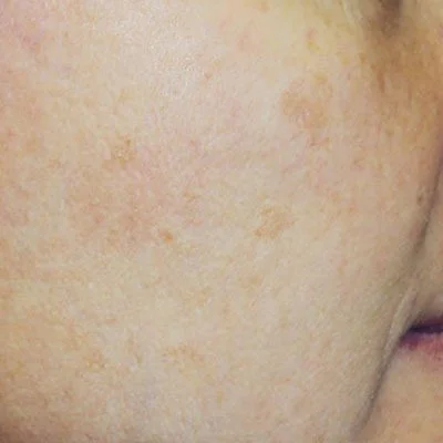 Laser Treatment For Acne Scars