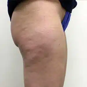 Mesolipo Treatment