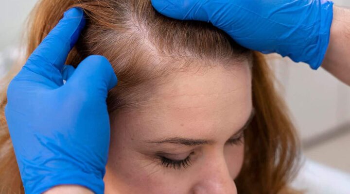 Mesotherapy For Hair Loss