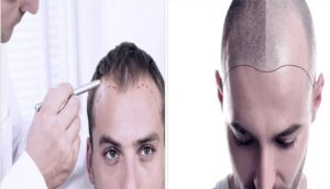 Hair Transplants