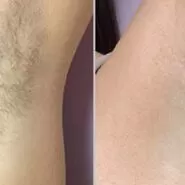 laser-hair-removal-before-after-1