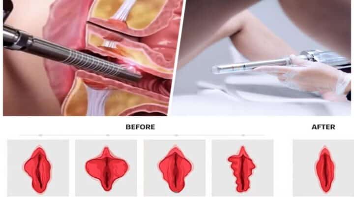 Laser Vaginal Tightening Cost
