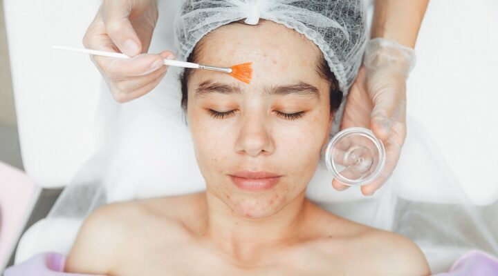 PRP Facial