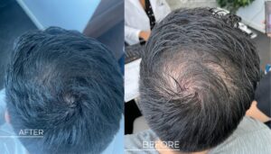  Stem cell therapy for hair loss treatment at Nexus Clinic, Malaysia 