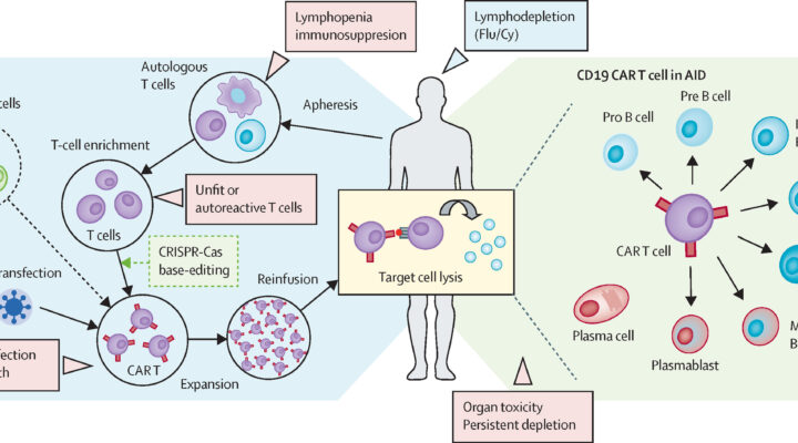 Stem cell therapy for autoimmune diseases at Nexus Clinic in Malaysia.