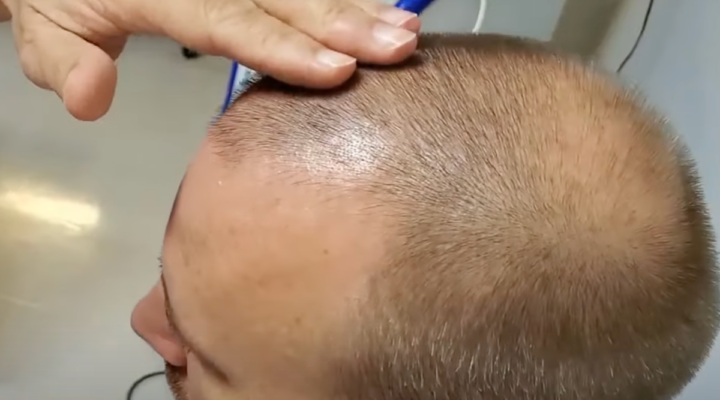 Stem cell therapy for hair loss treatment at Nexus Clinic, Malaysia