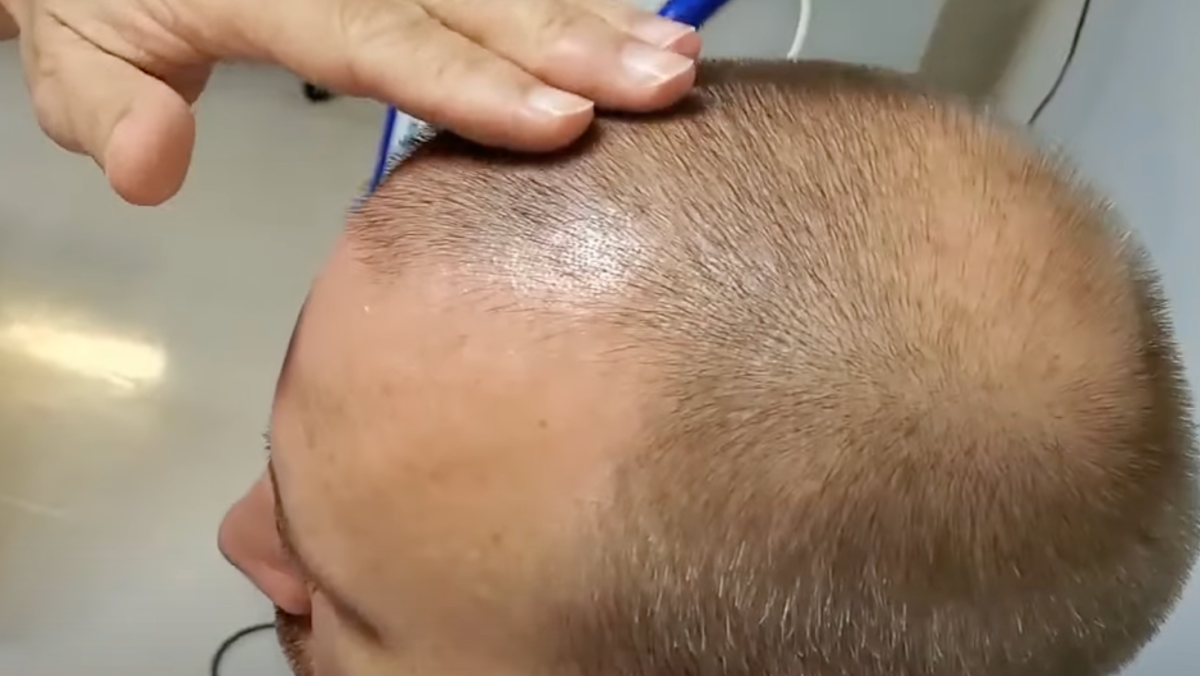 Stem cell therapy for hair loss treatment at Nexus Clinic, Malaysia