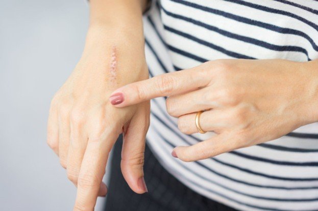 Scar treatment methods