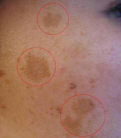 Melasma (Special Caution)