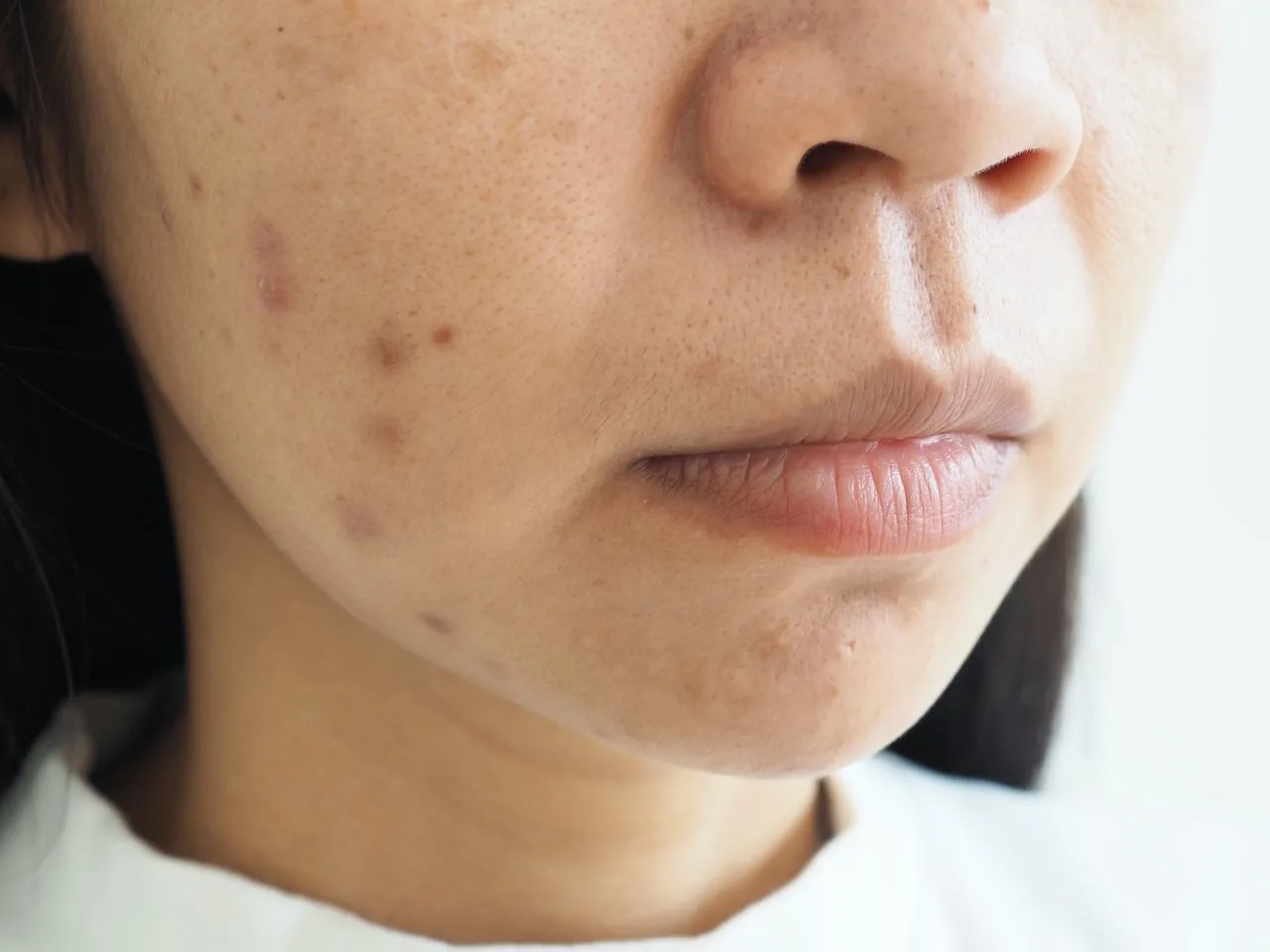 Post-acne marks (PIH)