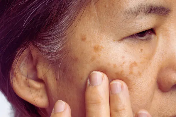 Sun spots and age spots